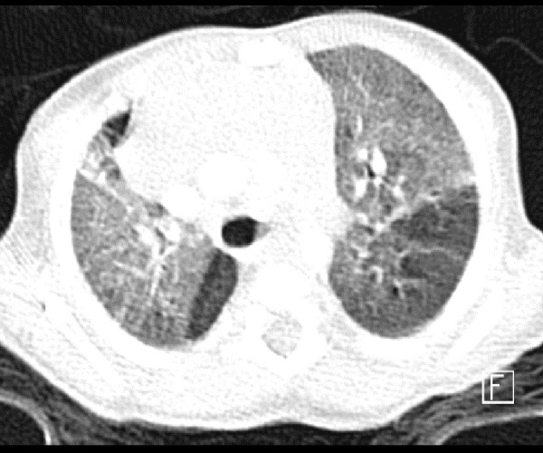 An Infant Presenting with Interstitial Lung Disease Diagnosed Later as Hunter Syndrome: A Case Report.