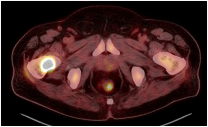 Management of Long Bones Metastatic Disease: Concepts That We All Know but Not Always Remember.