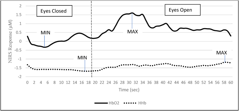 Long-term effects of multiple concussions on prefrontal cortex oxygenation during neurovascular coupling activation in retired male contact sport athletes