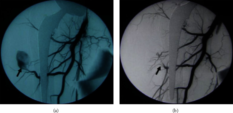 Endovascular Management of a Deep Femoral Artery Perforating Branch Pseudoaneurysm after Total Hip Arthroplasty: A Case Study.