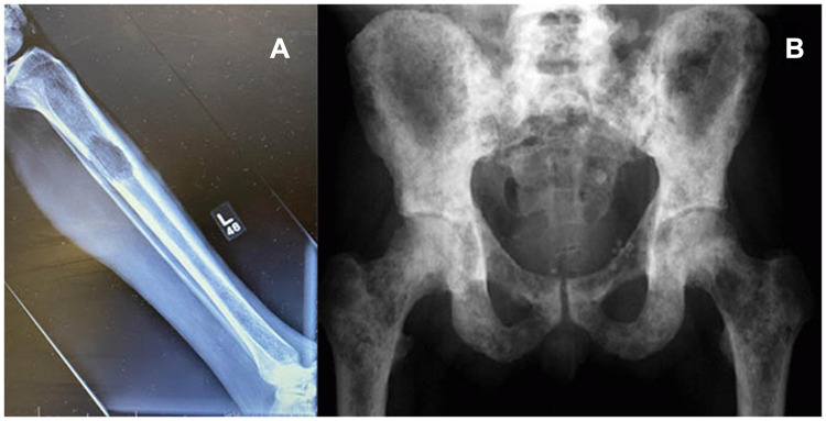 Management of Long Bones Metastatic Disease: Concepts That We All Know but Not Always Remember.