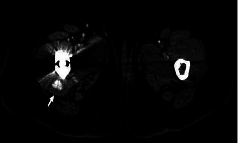 Endovascular Management of a Deep Femoral Artery Perforating Branch Pseudoaneurysm after Total Hip Arthroplasty: A Case Study.