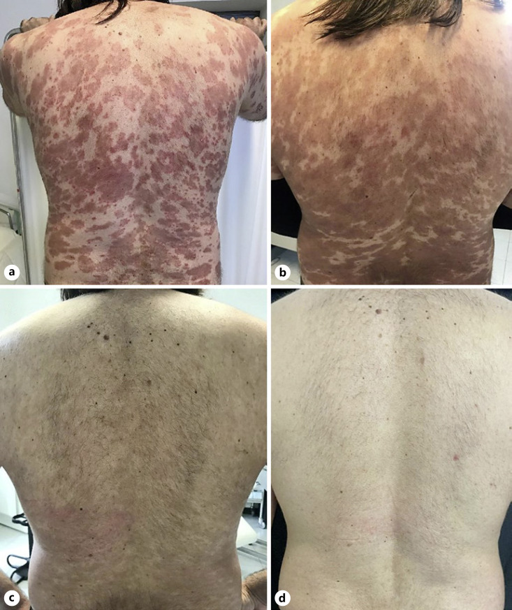 Severe Generalized Pustular Psoriasis Successfully Treated with Ixekizumab: A Case Report.