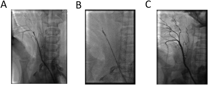 Evaluation of using a double helical, closed-cell stent-retriever (Skyflow) for thrombectomy procedures in acute arterial occlusion: A preclinical study and a clinical trial