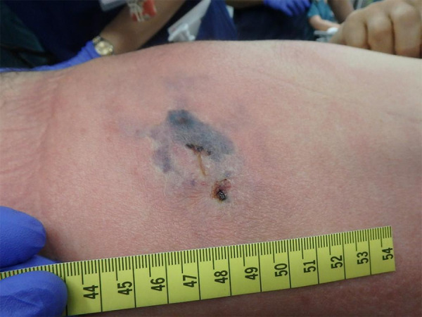 Necrotizing Soft-Tissue Infection of the Trunk Resulting From Wound Caused by a Centipede: A Case Report.
