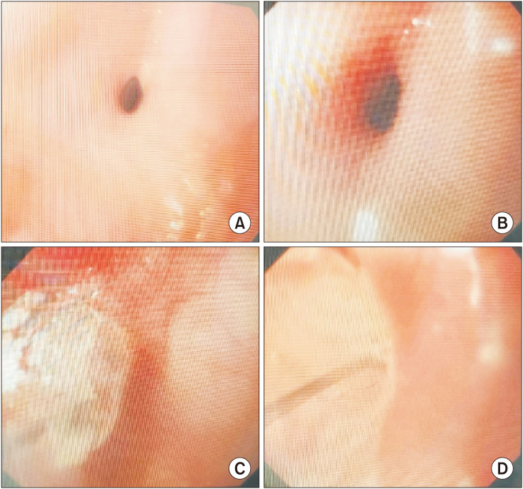 Postoperative Complications of Esophageal Atresia and Role of Endoscopic Balloon Dilatation in Anastomotic Strictures.