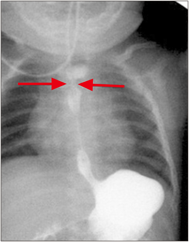 Postoperative Complications of Esophageal Atresia and Role of Endoscopic Balloon Dilatation in Anastomotic Strictures.