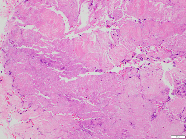 Necrotizing Soft-Tissue Infection of the Trunk Resulting From Wound Caused by a Centipede: A Case Report.
