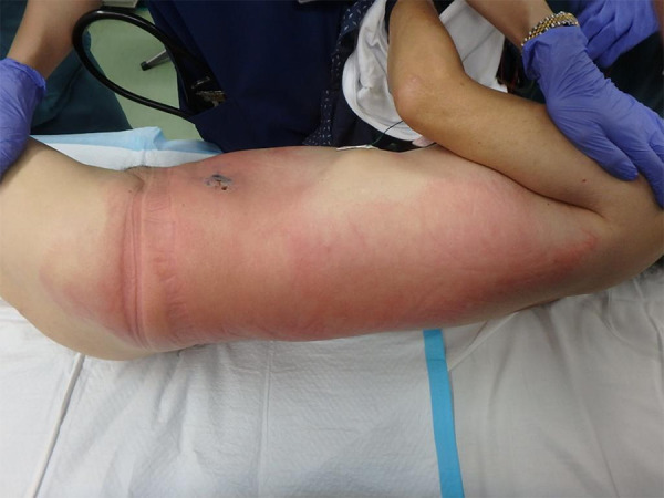 Necrotizing Soft-Tissue Infection of the Trunk Resulting From Wound Caused by a Centipede: A Case Report.