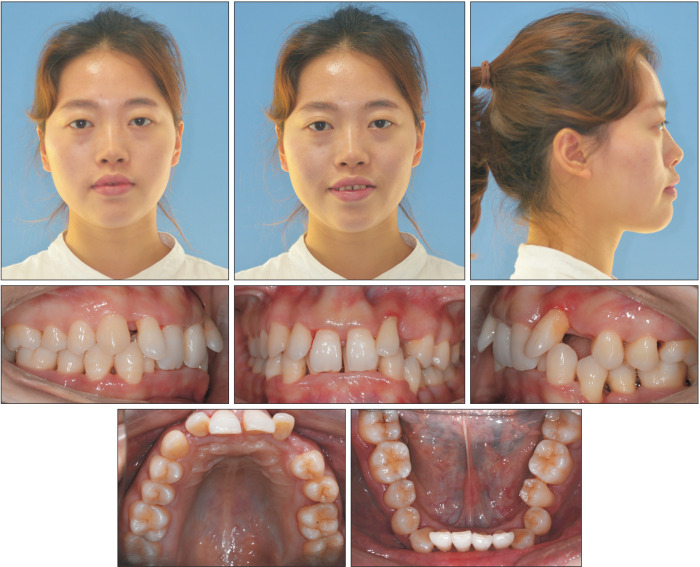 Orthodontic treatment with clear aligners for a patient with chronic periodontitis.