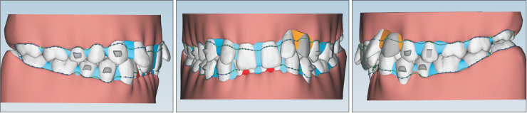 Orthodontic treatment with clear aligners for a patient with chronic periodontitis.