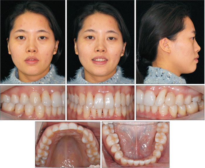 Orthodontic treatment with clear aligners for a patient with chronic periodontitis.