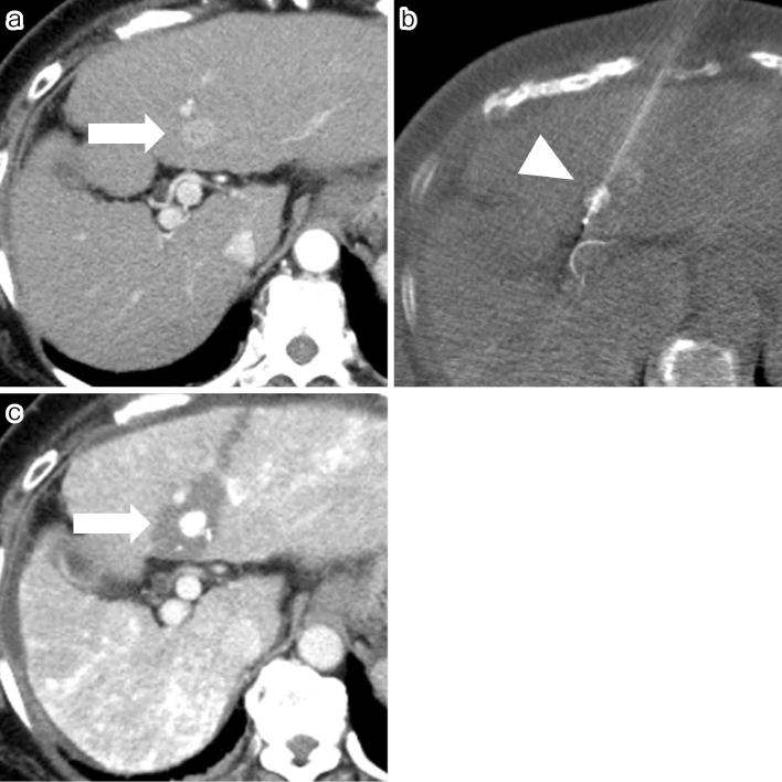 Clinical Experience of Percutaneous Radiofrequency Ablation Using an arfa RF ABLATION SYSTEM<sup>Ⓡ</sup> in Various Organs.