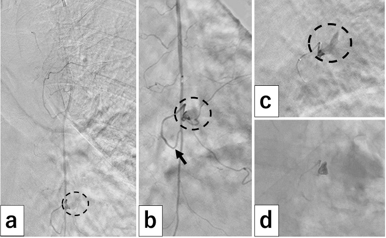 Transcatheter Arterial Embolization for Intramammary Hemorrhage Caused by a Seat Belt Injury: Case Series Including Experience with N-butyl-2-cyanoacrylate.