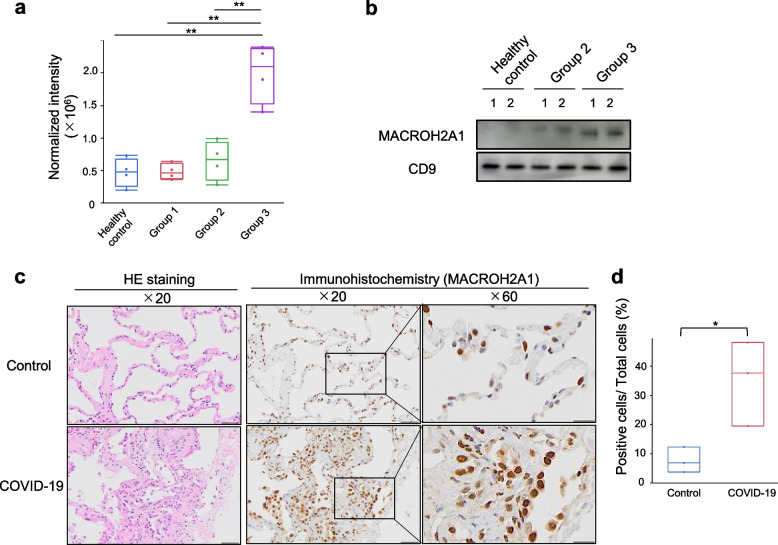 Next-generation proteomics of serum extracellular vesicles combined with single-cell RNA sequencing identifies MACROH2A1 associated with refractory COVID-19.