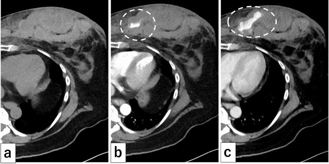 Transcatheter Arterial Embolization for Intramammary Hemorrhage Caused by a Seat Belt Injury: Case Series Including Experience with N-butyl-2-cyanoacrylate.