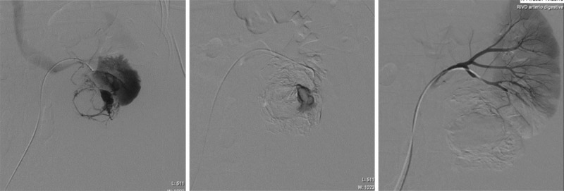 Ruptured Renal Angiomyolipoma.