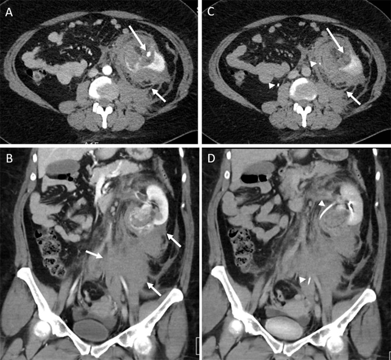 Ruptured Renal Angiomyolipoma.