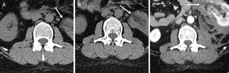 Ruptured Renal Angiomyolipoma.