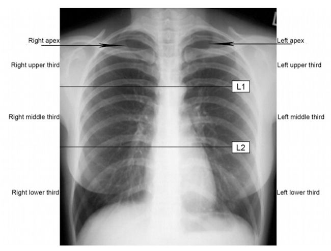 A scoping study of pulmonary paracoccidioidomycosis: severity classification based on radiographic and tomographic evaluation.