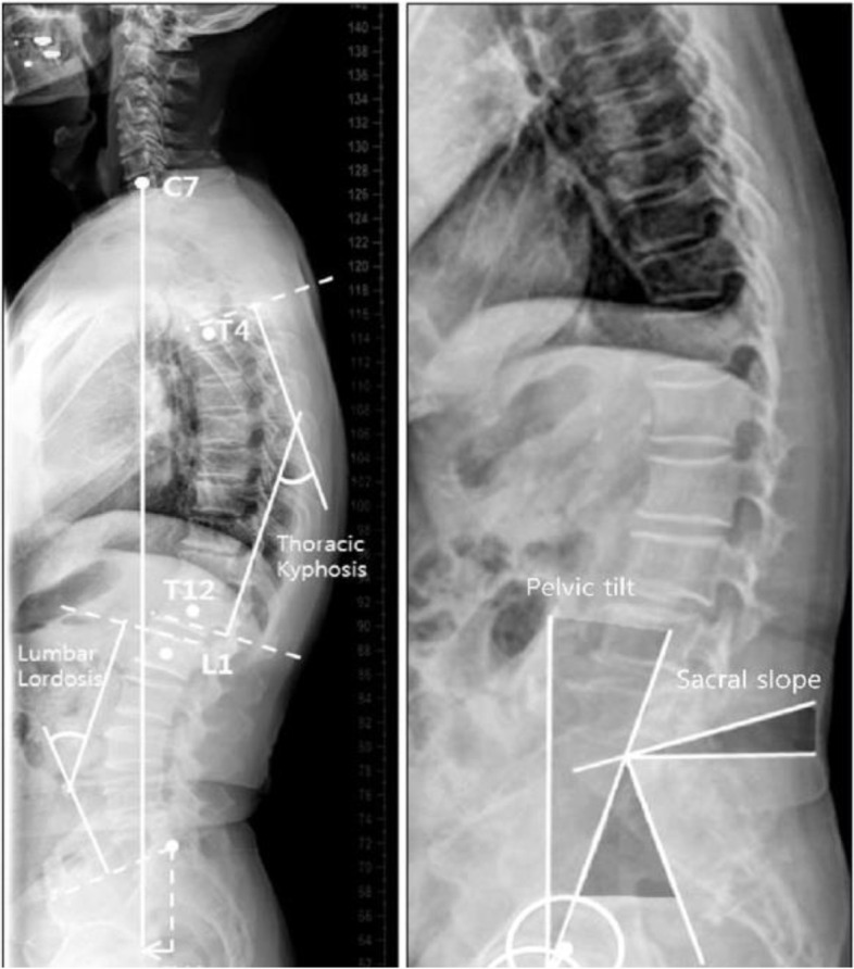 Functional outcome of surgical management of low mid-grade lumbar spondylolisthesis when considering the sagittal balance parameters preoperatively: a prospective study.