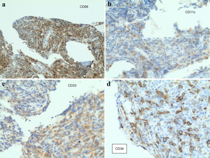 Extramedullary Myeloid Leukemia in the Setting of a Myeloproliferative Neoplasm.