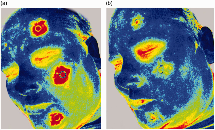 Galcanezumab modulates Capsaicin-induced C-fiber reactivity.