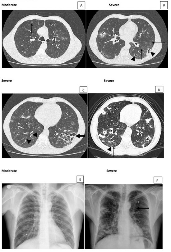 A scoping study of pulmonary paracoccidioidomycosis: severity classification based on radiographic and tomographic evaluation.