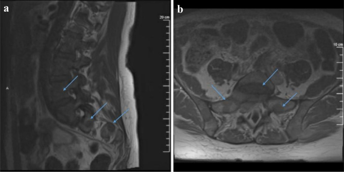 Extramedullary Myeloid Leukemia in the Setting of a Myeloproliferative Neoplasm.