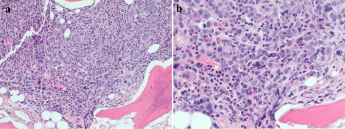 Extramedullary Myeloid Leukemia in the Setting of a Myeloproliferative Neoplasm.