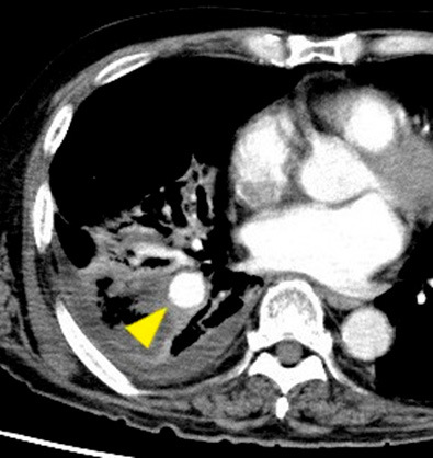 Successful Intrasaccular Coil Embolization of Mycotic Pulmonary Artery Pseudoaneurysm Using the Balloon Remodeling Technique.