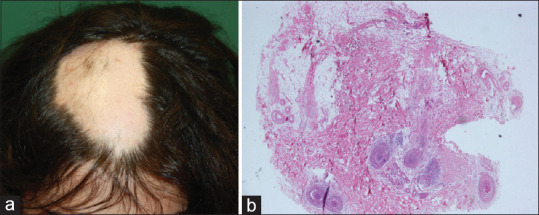 The Association between the Number of Follicular Stelae and Severity and Treatment Response of Alopecia Areata Cases: A Retrospective Study.