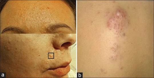 Facial Trichoepitheliomas Revealing the Rare Brooke-Spiegler Syndrome.