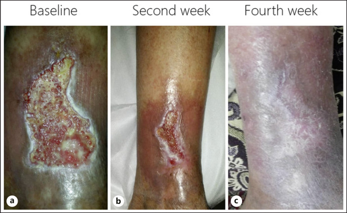 Treatment of Chronic Venous Ulcer with Cold Atmospheric Plasma Jet.