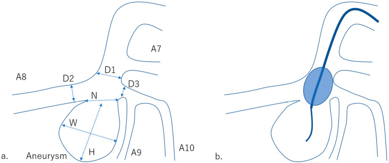 Successful Intrasaccular Coil Embolization of Mycotic Pulmonary Artery Pseudoaneurysm Using the Balloon Remodeling Technique.