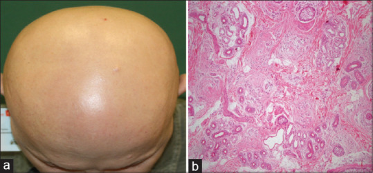 The Association between the Number of Follicular Stelae and Severity and Treatment Response of Alopecia Areata Cases: A Retrospective Study.