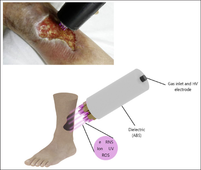 Treatment of Chronic Venous Ulcer with Cold Atmospheric Plasma Jet.