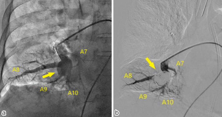 Successful Intrasaccular Coil Embolization of Mycotic Pulmonary Artery Pseudoaneurysm Using the Balloon Remodeling Technique.