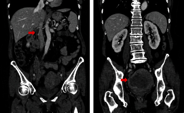 Multiple Imaging and Surgical Characteristics in Cardiac Metastasis from Undifferentiated Uterine Sarcoma.