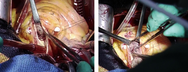 Multiple Imaging and Surgical Characteristics in Cardiac Metastasis from Undifferentiated Uterine Sarcoma.