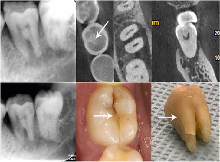 Diagnosis of cracked tooth: Clinical status and research progress