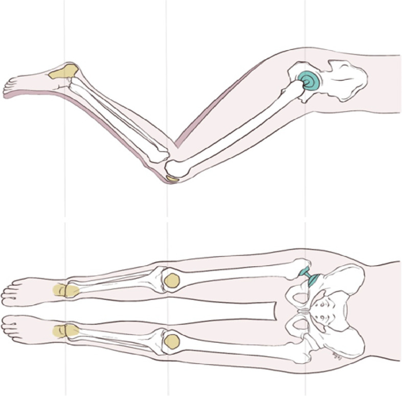 A bone-conserving revision stem for unstable intertrochanteric fractures of the geriatric osteoporotic population.