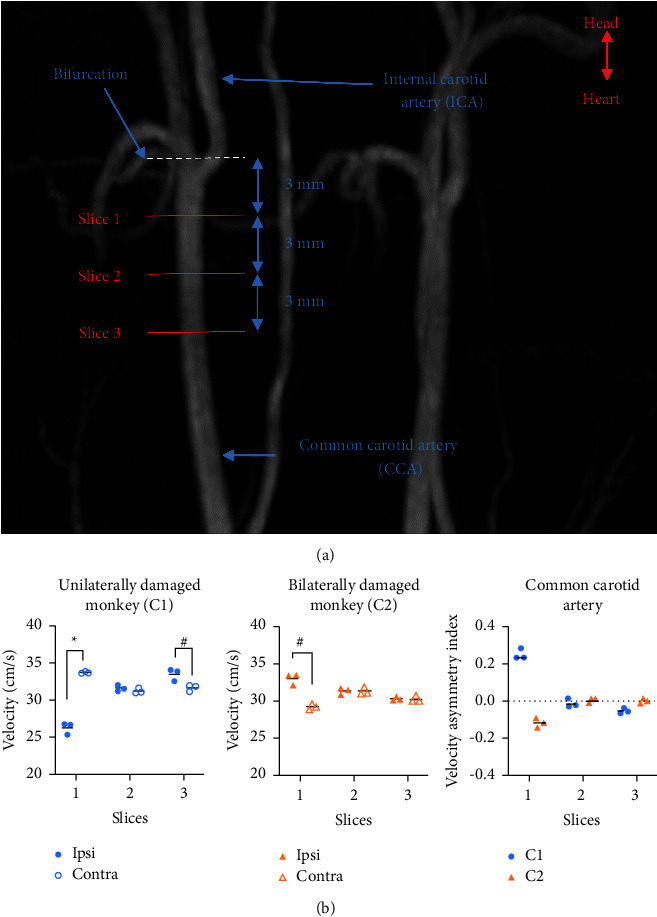 Determination of the Unilaterally Damaged Region May Depend on the Asymmetry of Carotid Blood Flow Velocity in Hemiparkinsonian Monkey: A Pilot Study.