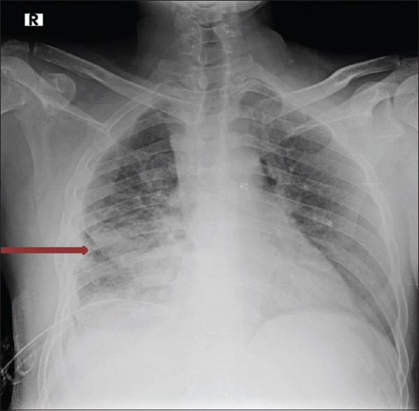 <i>Delftia acidovorans</i>: An Unusual Pathogen from an Adenocarcinoma Lung Patient with Pleural Effusion.