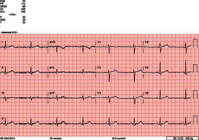 A Case of Profound Bradycardia in Endurance Athlete with Severe Anorexia Nervosa.