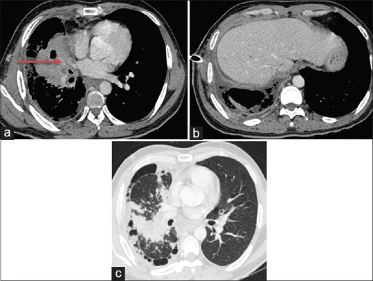 <i>Delftia acidovorans</i>: An Unusual Pathogen from an Adenocarcinoma Lung Patient with Pleural Effusion.