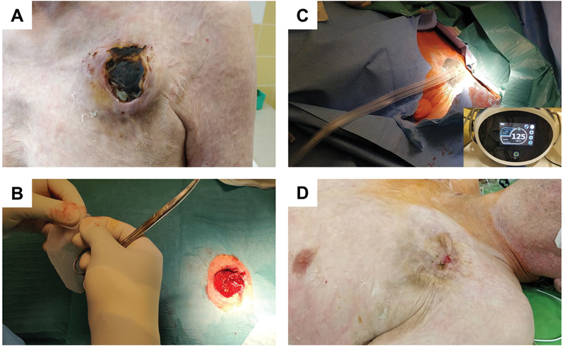 Concomitant Transatrial and Transapical CRT-D Lead Implantation in a Patient with Chest Burn Injury.