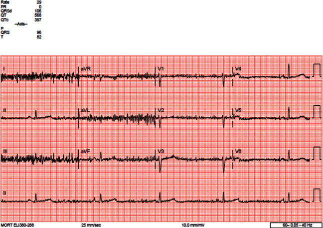 A Case of Profound Bradycardia in Endurance Athlete with Severe Anorexia Nervosa.