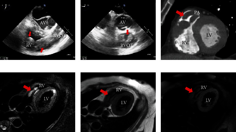 Multiple Imaging and Surgical Characteristics in Cardiac Metastasis from Undifferentiated Uterine Sarcoma.