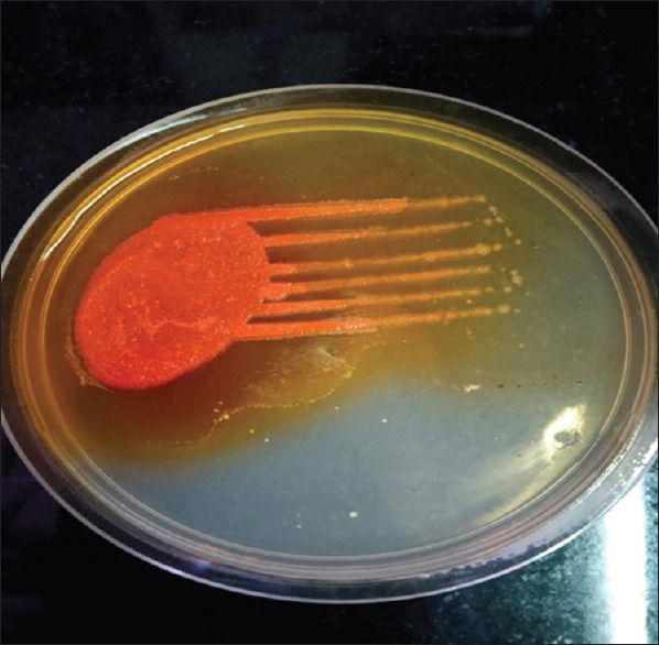 <i>Delftia acidovorans</i>: An Unusual Pathogen from an Adenocarcinoma Lung Patient with Pleural Effusion.